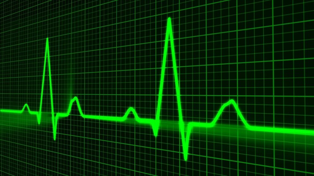 Atrial fibrillation estimated to be three times more common than previously thought